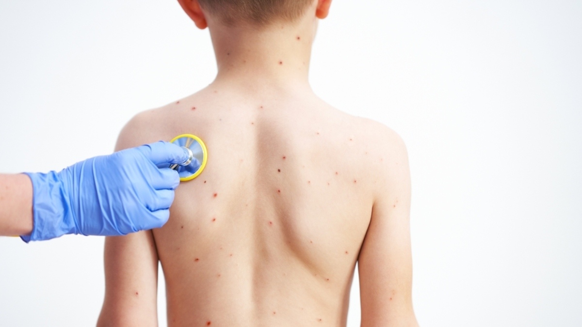 Monkeypox First Confirmed Pediatric Case in Florida