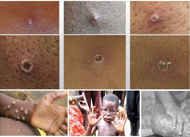 WHO decision global emergency for monkeypox